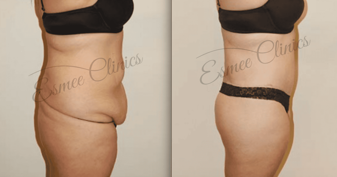 Before and After img